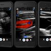 portable-ultrasound-butterfly-iq-2.jpg