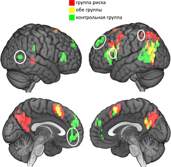 suicidal-feelings-brain-scans-1.jpg